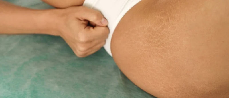 Estrías: por qué aparecen y cómo prevenirlas